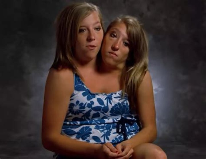 Bateson Conjoined Twins Are A ‘Miracle’ As Parents Share, Photos On Reddit