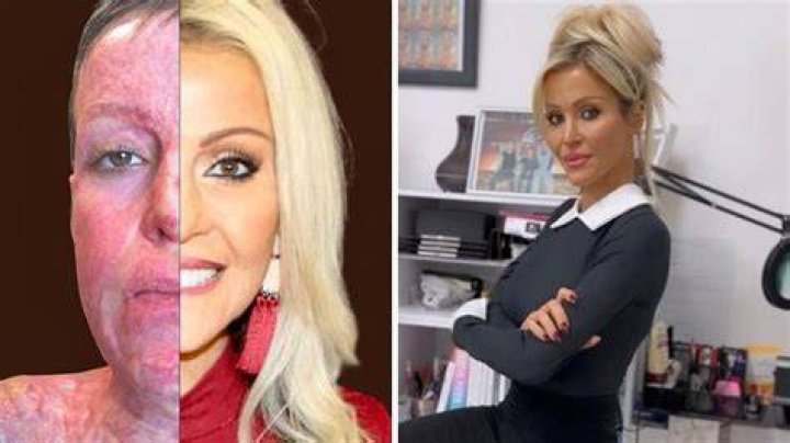 
Dana Vulin An Acid Attack Victim On A Quest To Make Scars Sexy In Lingerie Transformation 