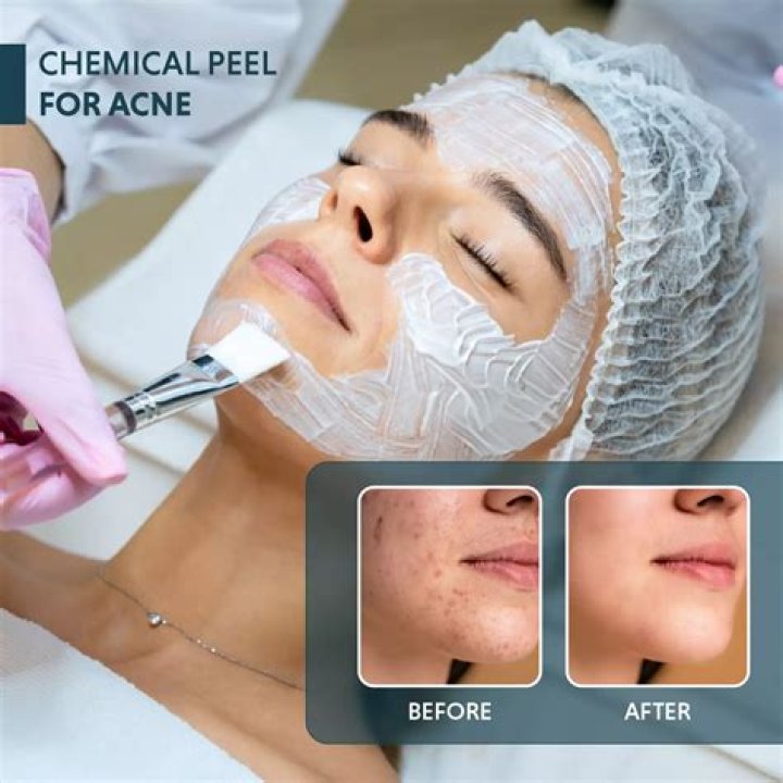 
Myths and facts about chemical peeling 