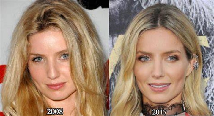 Truth About Annabelle Wallis Nose Job